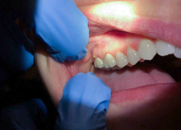 Best Emergency Care for Gum Disease in Farmingdale, NJ