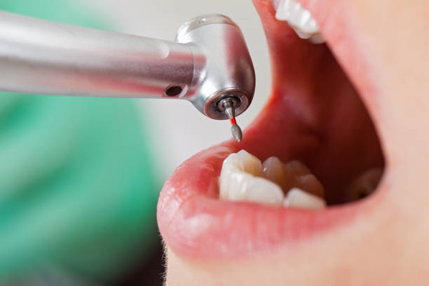 Best Lost Filling or Crown Replacement in Farmingdale, NJ